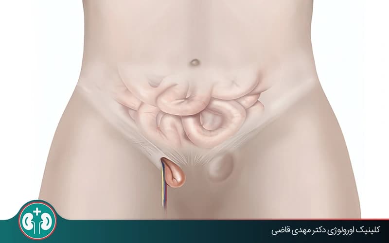 هل يسبب فتق الخصية العقم؟ مراجعة علمية وطرق الوقاية