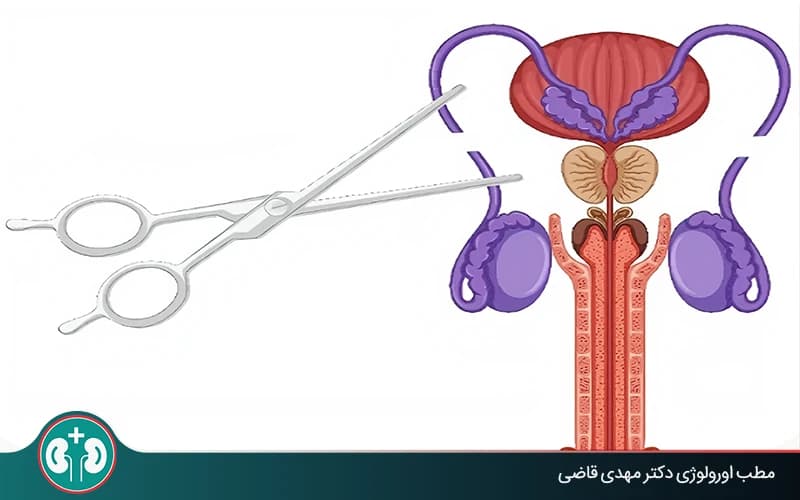 Can Pregnancy Still Happen After Vasectomy?