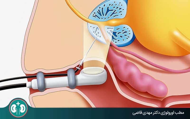 Risks and Side Effects of Prostate Biopsy: Complete Guide to Care After the Test