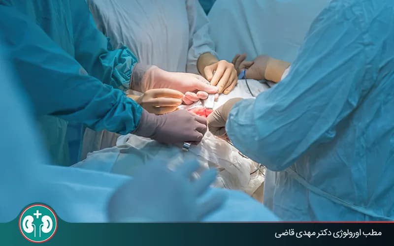 Open Kidney Stone Surgery: Definitive Treatment for Large Stones