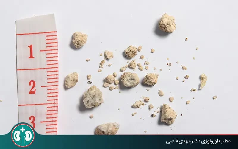 دفع حصى الكلى من ٤ إلى ١٠ مليمترات: الأعراض وطرق العلاج