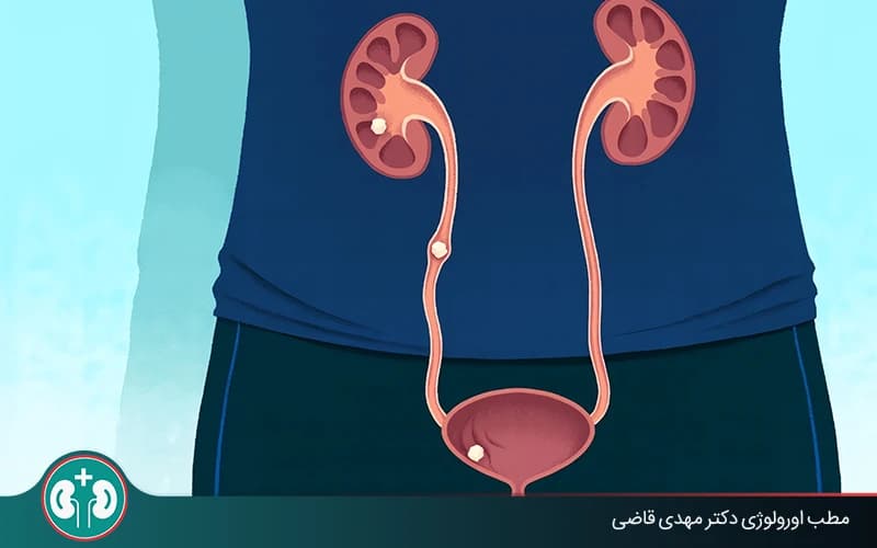 ما أعراض نزول حصى الكلى ومتى يجب مراجعة الطبيب؟