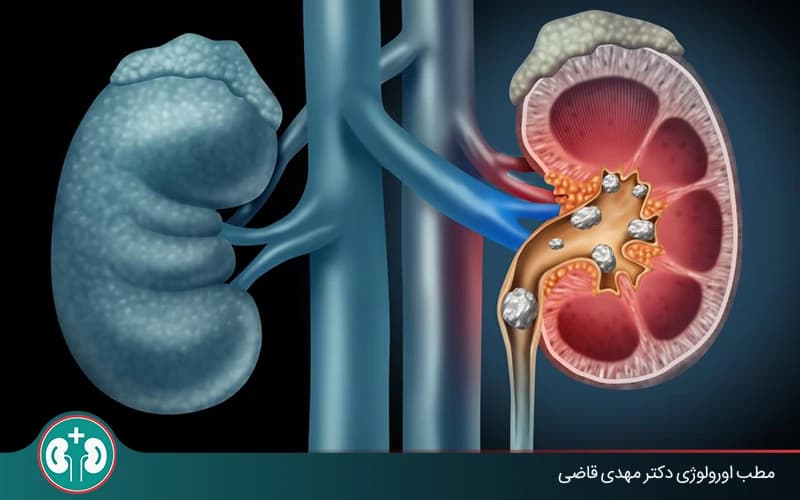 ما مضاعفات حصى الكلى، وهل حصى الكلى خطيرة؟