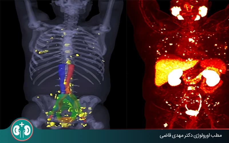 اگر سرطان پروستات به استخوان بزند چه می‌شود؟