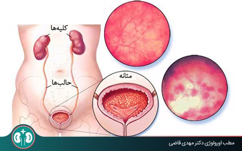 Cystitis Treatment: Duration in Men and Women