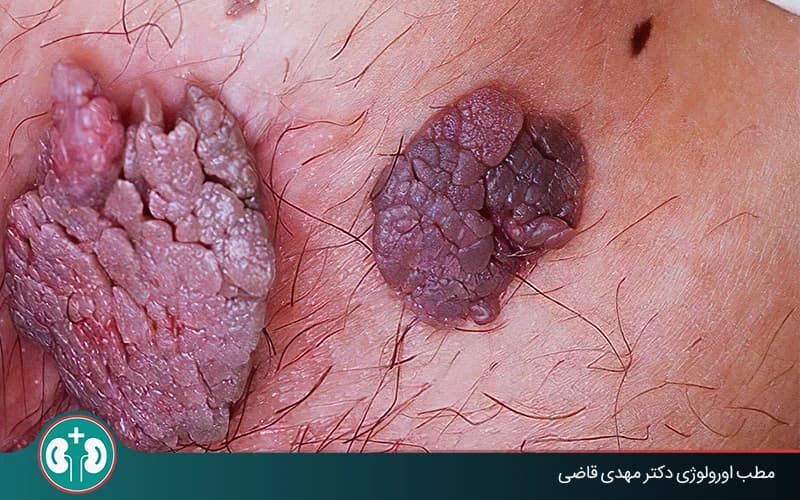 ما أعراض الثآليل التناسلية منخفضة الخطورة؟ التشخيص والعلاج