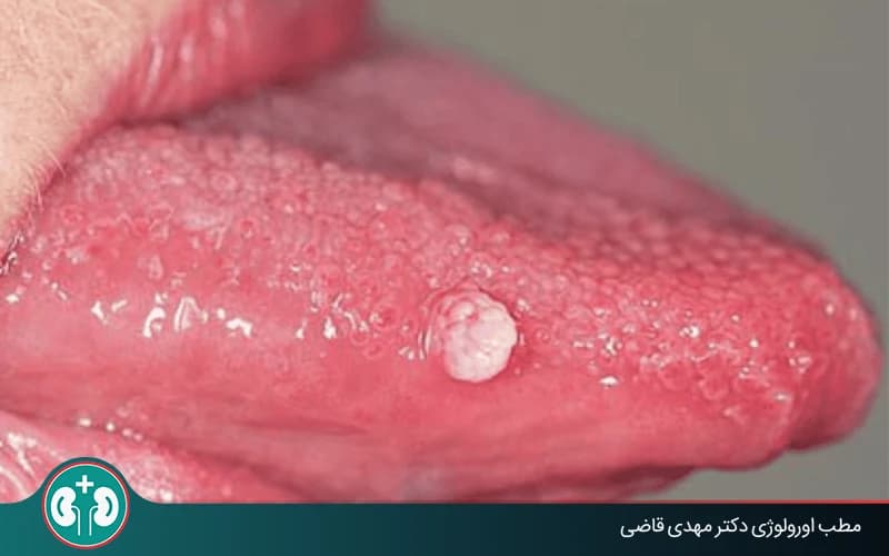 أعراض الثآليل التناسلية في الفم وطرق التشخيص والعلاج