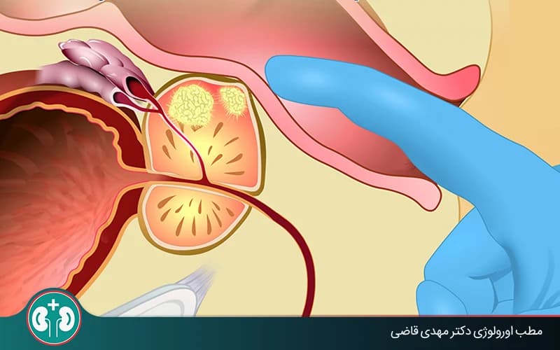 معاینۀ پروستات از طریق مقعد (DRE) چگونه است؟ مراحل و نکات