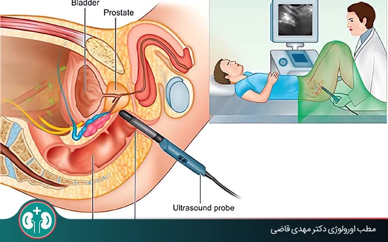 ما هو التصوير بالموجات فوق الصوتية عبر المستقيم للبروستاتا ولماذا يُجرى؟