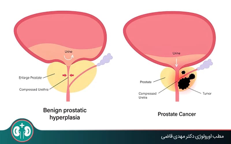 هل يتحول تضخم البروستاتا الحميد إلى سرطان البروستاتا؟