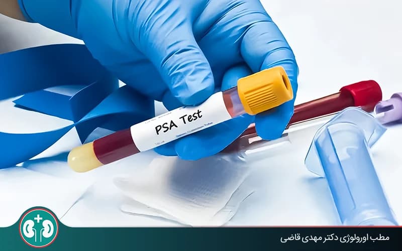تفسیر عدد PSA بعد از عمل پروستات؛ آیا افزایش آن به معنای سرطان است؟