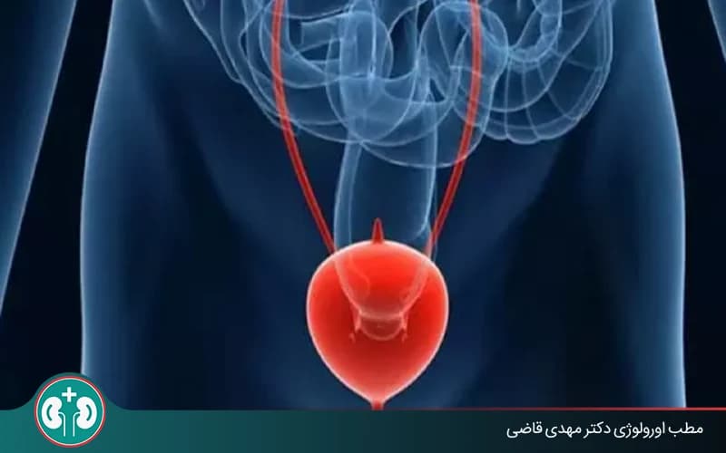 کیست مثانه چیست؟ علائم، علل و روش‌های تشخیص و درمان