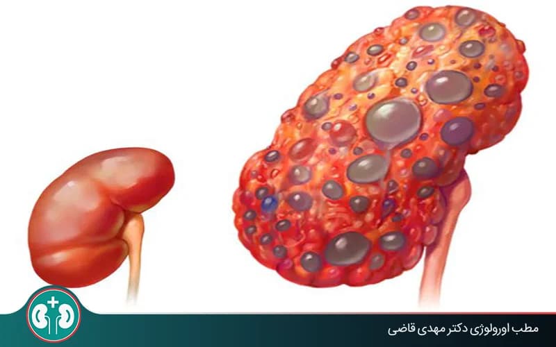ما داء الكلى متعددة الكيسات؟ (لدى الجنين والبالغين)