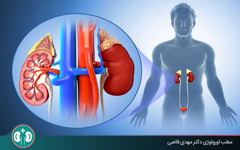 ما هو التهاب الحويضة والكلية؟ أعراض عدوى الكلى والتشخيص والعلاج