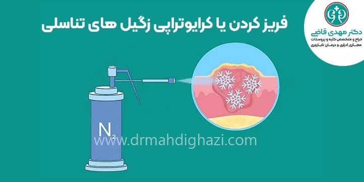 تجميد الثآليل التناسلية أو علاجها بالتبريد