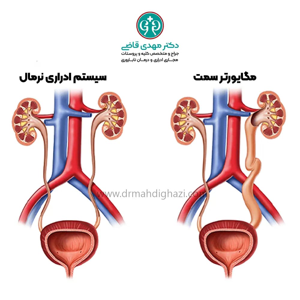 مقایسه مگایورتر و سیستم ادراری نرمال
