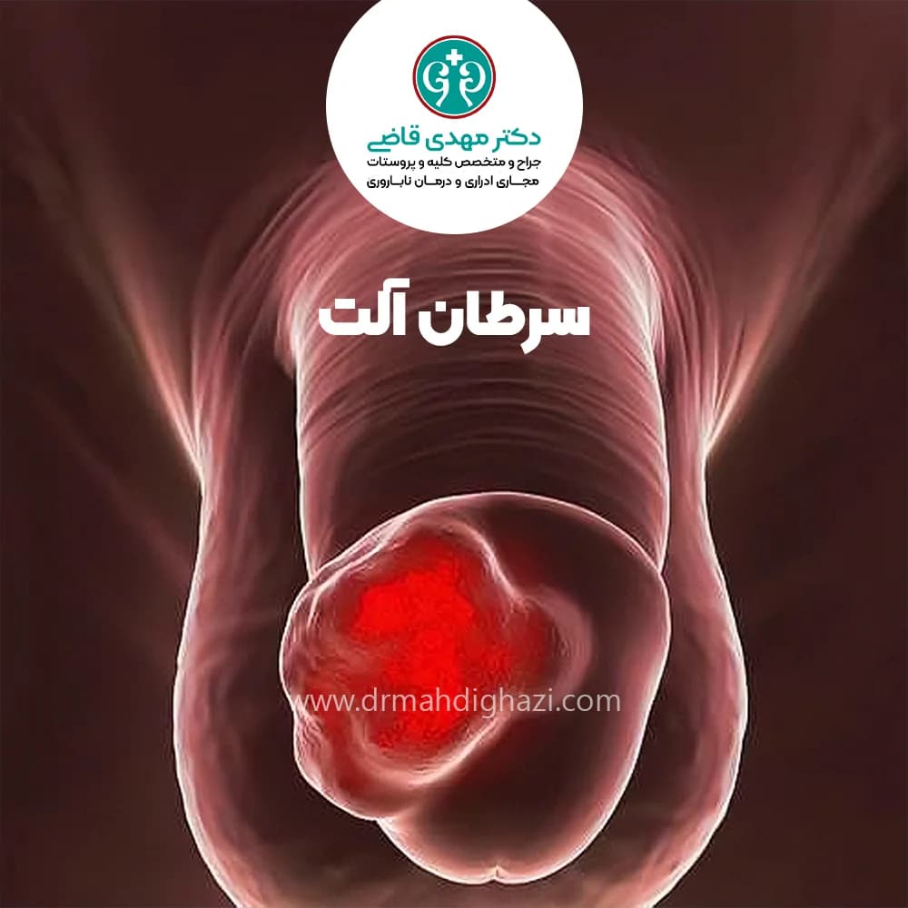 الدكتور مهدي قاضي -سرطان آلت تناسلی درمان و علائم
