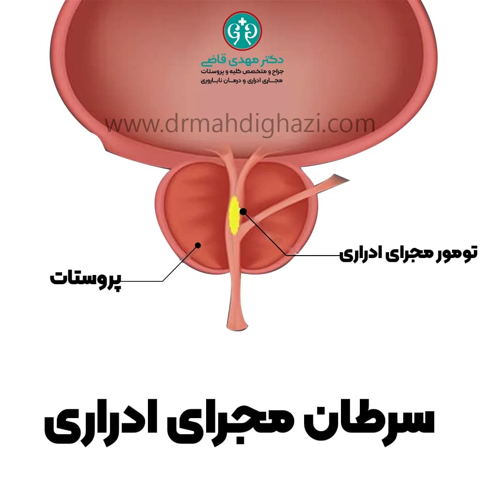 دکتر قاضی- سرطان مجرای ادراری