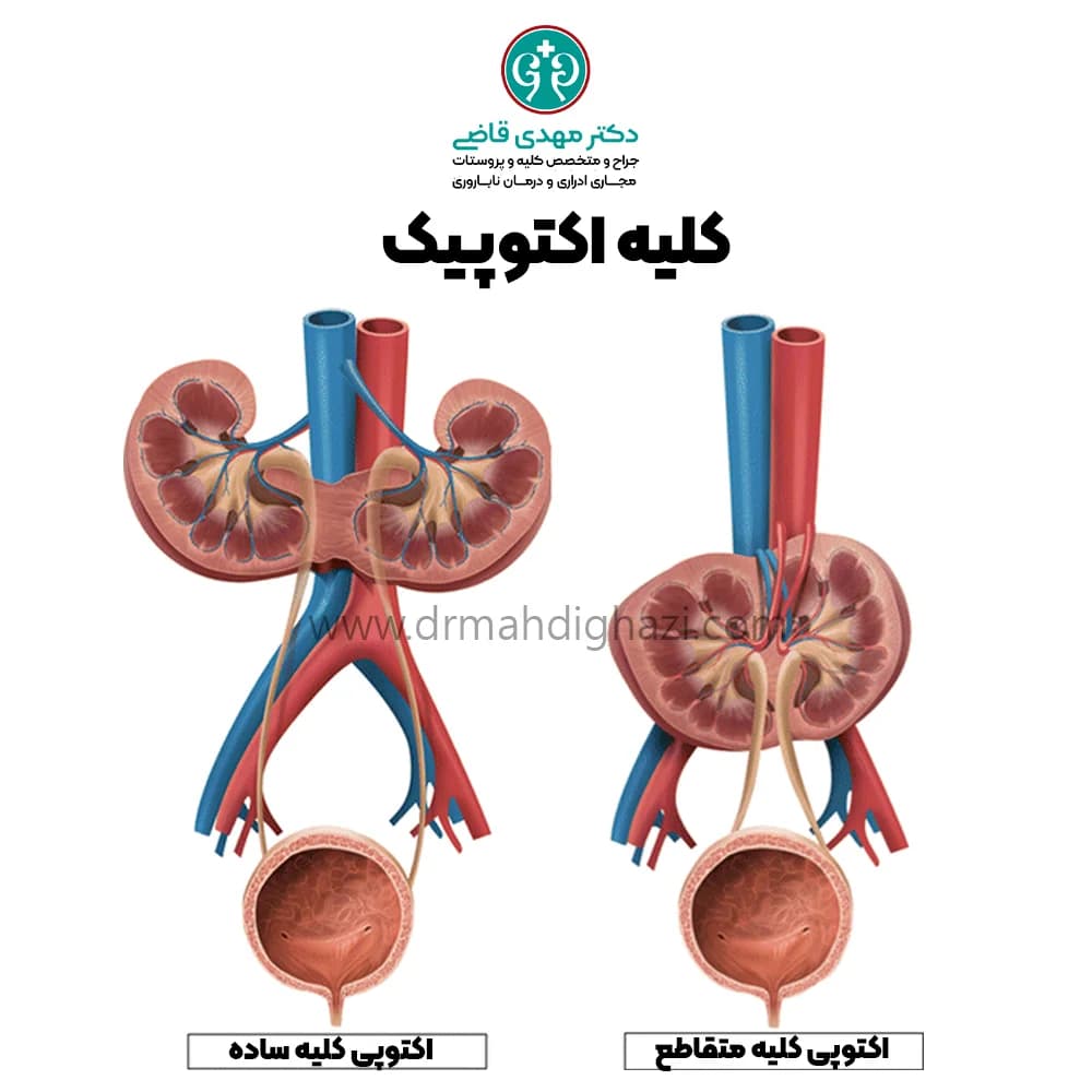 دکتر قاضی-کلیه اکتوپیک