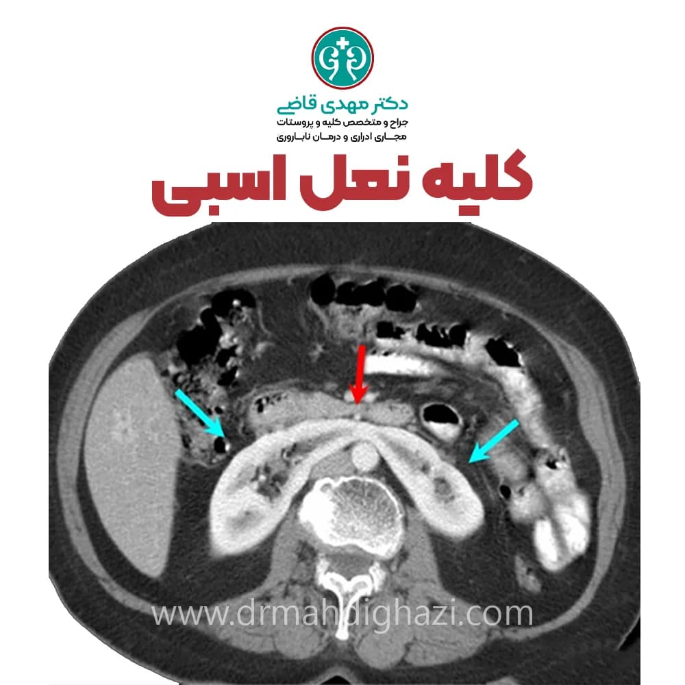 دکتر قاضی-کلیه نعل اسبی