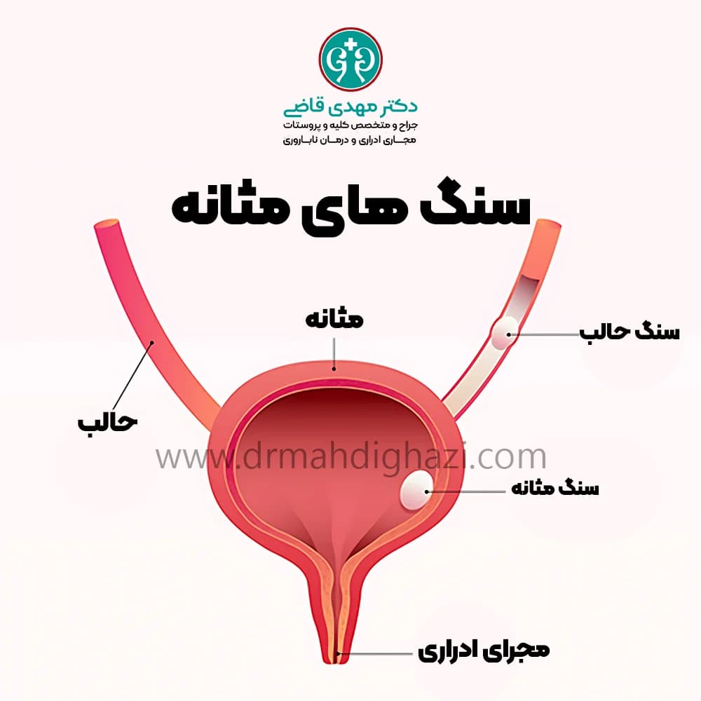 الدكتور مهدي قاضي - سنگ مثانه