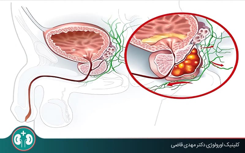آیا التهاب پروستات باعث سرطان میشود؟ بررسی علمی و توصیههای پیشگیرانه