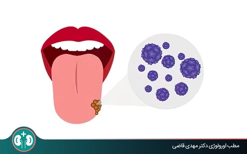 راه های درمان زگیل تناسلی دهان؛ از درمانهای دارویی تا روشهای تخصصی