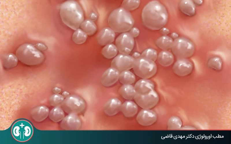 تبخال تناسلی هر چند وقت عود میکند؟ عوامل محرک و روشهای کاهش تکرار