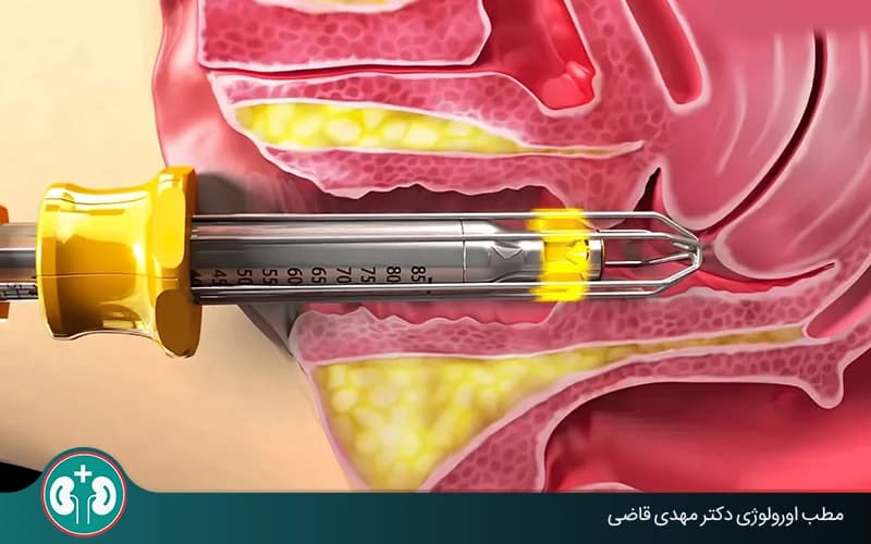 Who Is Laser Treatment for Bladder Prolapse Suitable For?