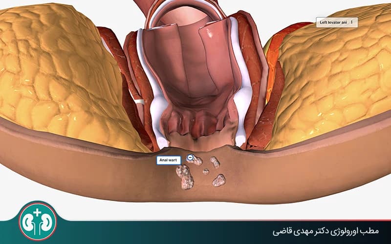 Anal genital warts in Women: Symptoms, Pictures, Diagnosis, and Treatment