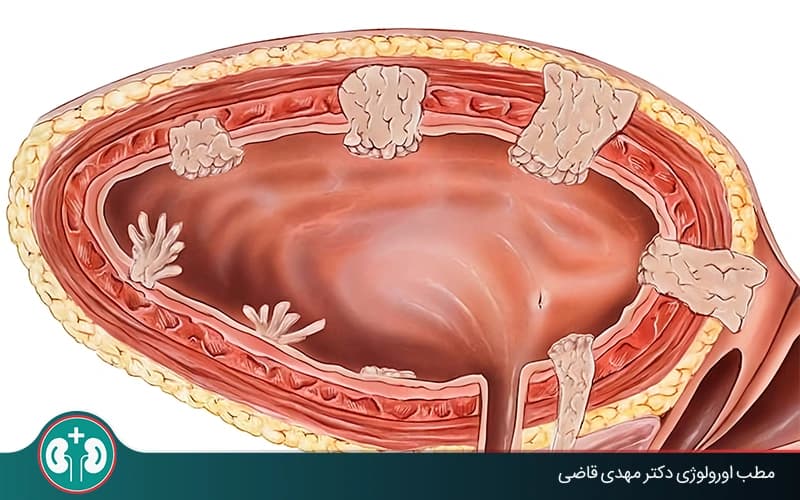 What Is a Bladder Polyp and How Is It Treated?