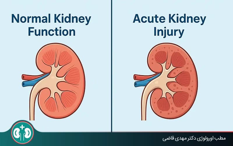 نارسایی حاد کلیه چیست؟ (علائم، مراحل درمان + رژیم غذایی)
