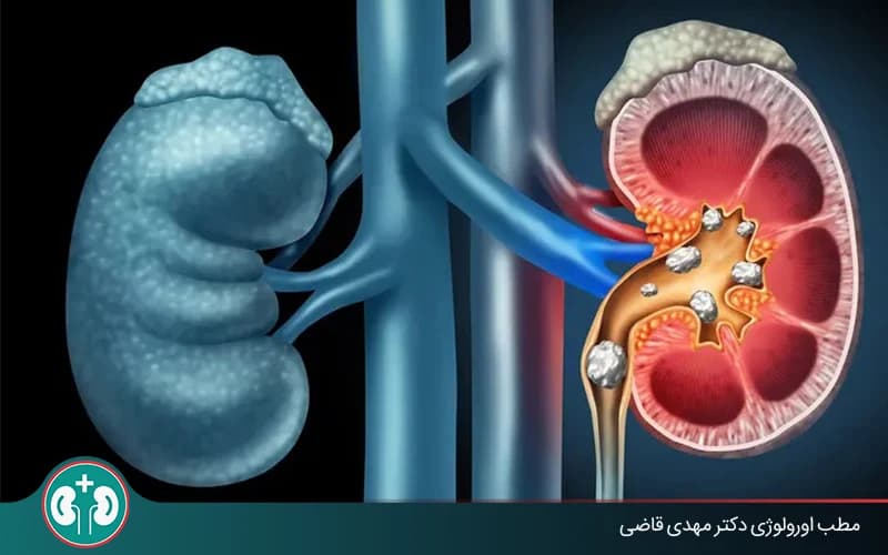 سنگ کلیه در حالب چگونه دفع میشود؟