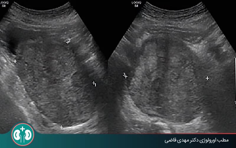 سونوگرافی پروستات؛ روشهای انجام + تفسیر