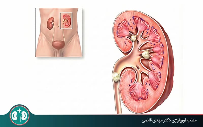 آیا سنگ کلیه میتواند باعث از کار افتادن کلیه شود؟