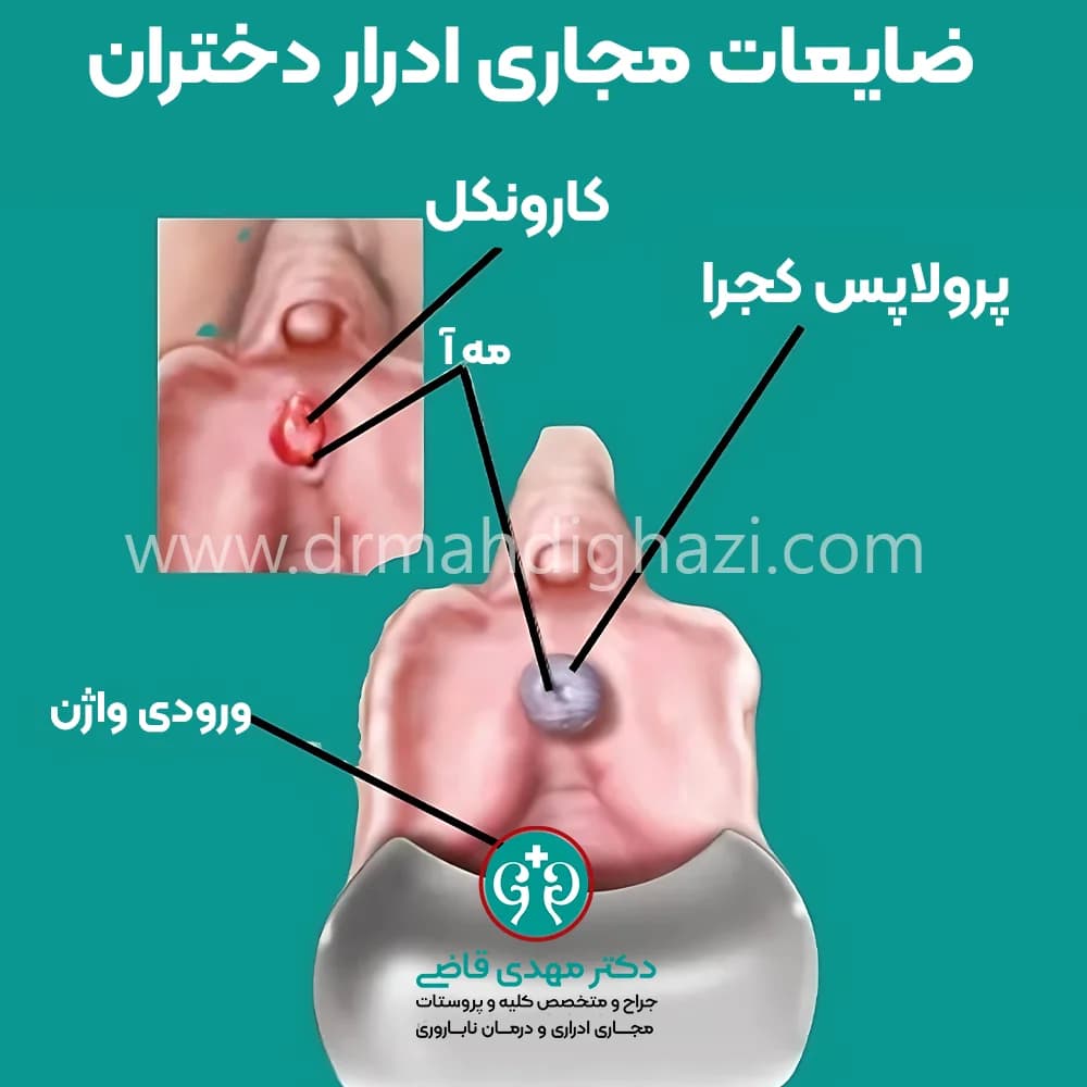 دکتر قاضی - • پیشگیری از عوارض تودههای خوش خیم مجرای ادرار در دختران