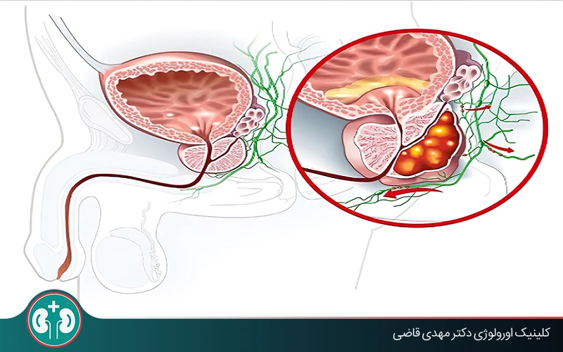 آیا التهاب پروستات باعث سرطان می‌شود؟ بررسی علمی و توصیه‌های پیشگیرانه