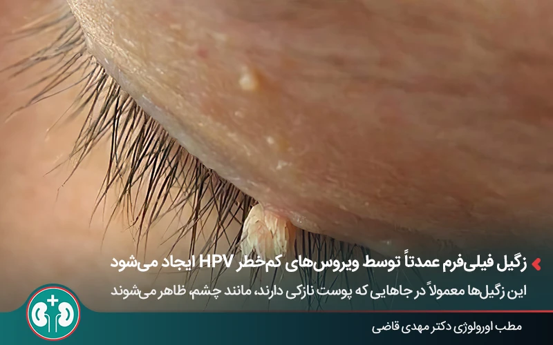 عکس زگیل فیل‌فرم