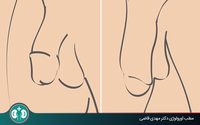 همه چیز درباره روشهای بزرگ کردن آلت تناسلی؛ روشهای علمی و غیرعلمی