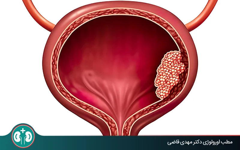 آیا سرطان مثانه درمان قطعی دارد؟ بررسی شانس بهبودی