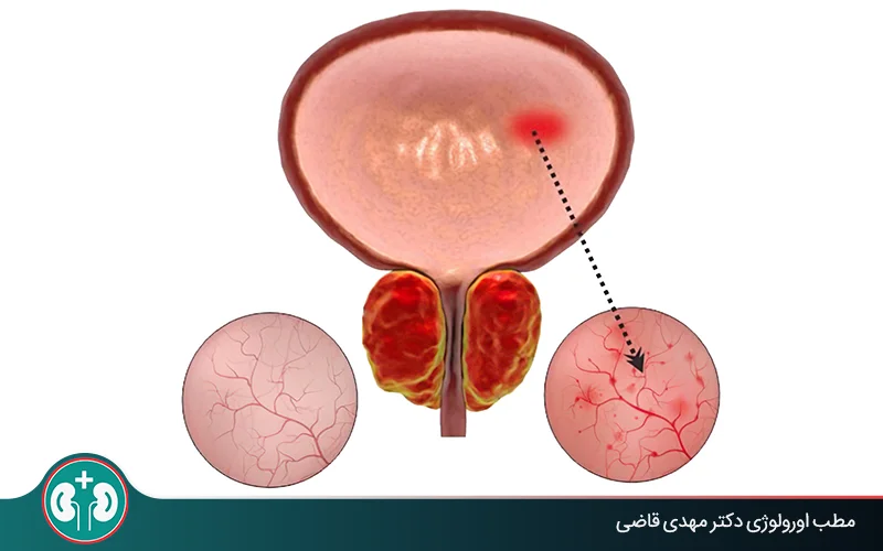 ما هو التهاب المثانة النزفي وكيف يُعالج؟