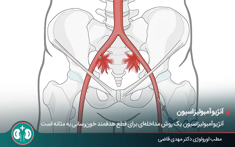 صورة توضيحية لقسطرة داخل شريان - الانصمام الوعائي