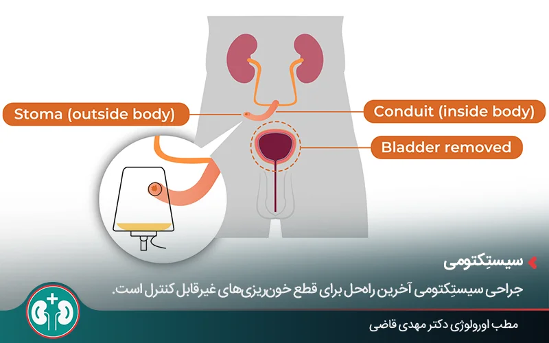 صورة توضيحية تُظهر إزالة المثانة وتجمع البول في كيس