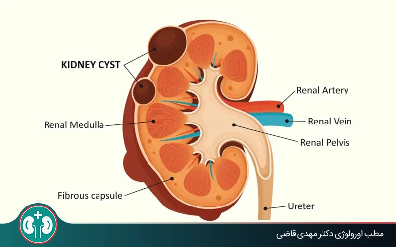 ما هو الكيس القشري في الكلى؟ الأعراض والتشخيص والعلاج