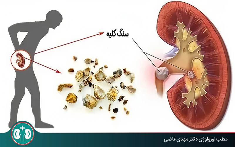 What Happens If a Kidney Stone Enters the Urinary Tract?