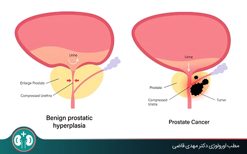 Can Benign Prostatic Hyperplasia Turn Into Prostate Cancer?