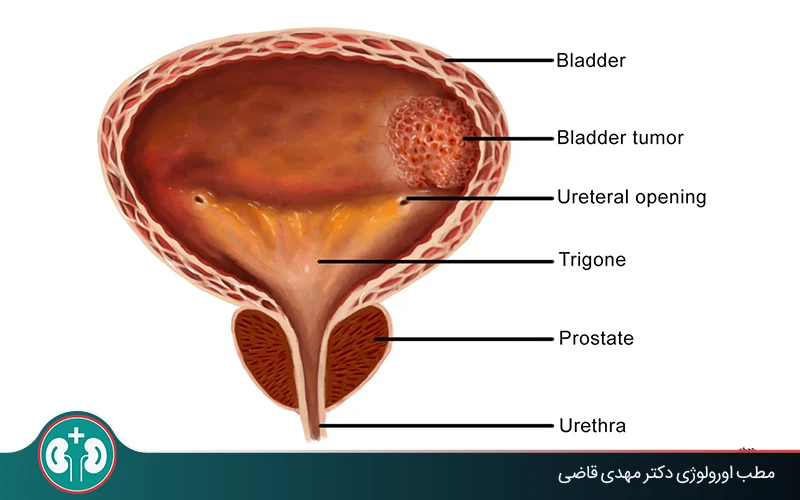 What Is a Benign Bladder Tumor? How It Differs from Bladder Cancer