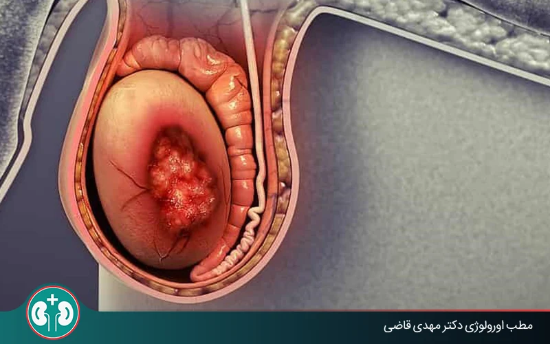 Is Every Testicular Lump a Sign of Cancer?