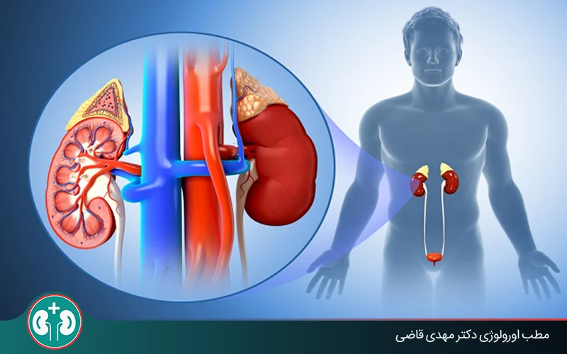 ما هو التهاب الحويضة والكلية؟ أعراض عدوى الكلى والتشخيص والعلاج