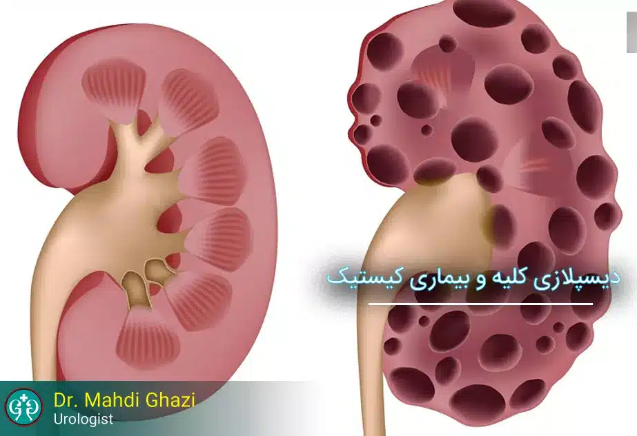 Cystic Kidney Diseases and Renal Dysplasia: Symptoms, Diagnosis, and Treatment